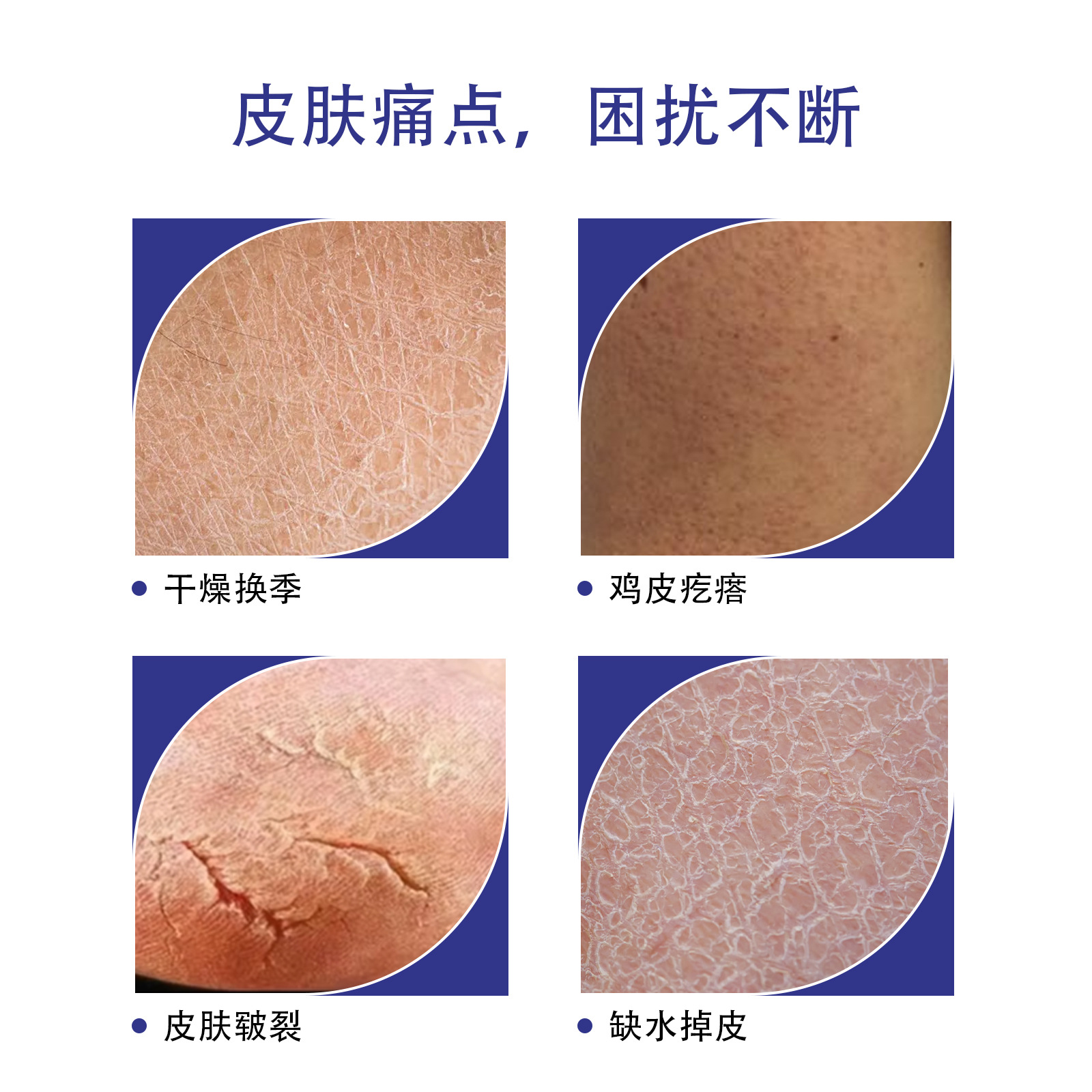 Cross-Border Urea Cream 40% Vitamin E Exfoliation, Anti-Drying, Anti-Cracking, Moisturizing and Moisturizing Manufacturer Hand and Foot Care Cream