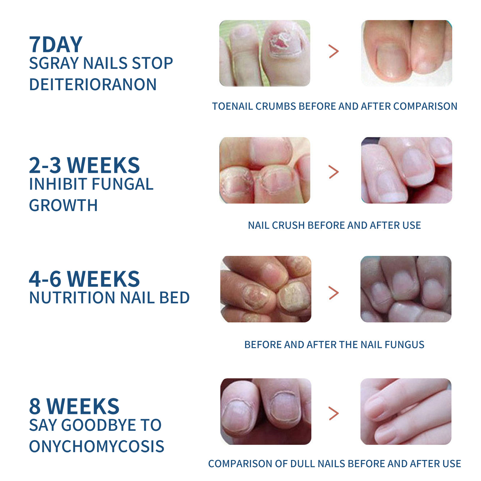 Eelhoe Toenail Care Patch Onychomycosis Care Toenail Soft Nail Ingrown Nail Thickening Bright Nail Groove Care Patch