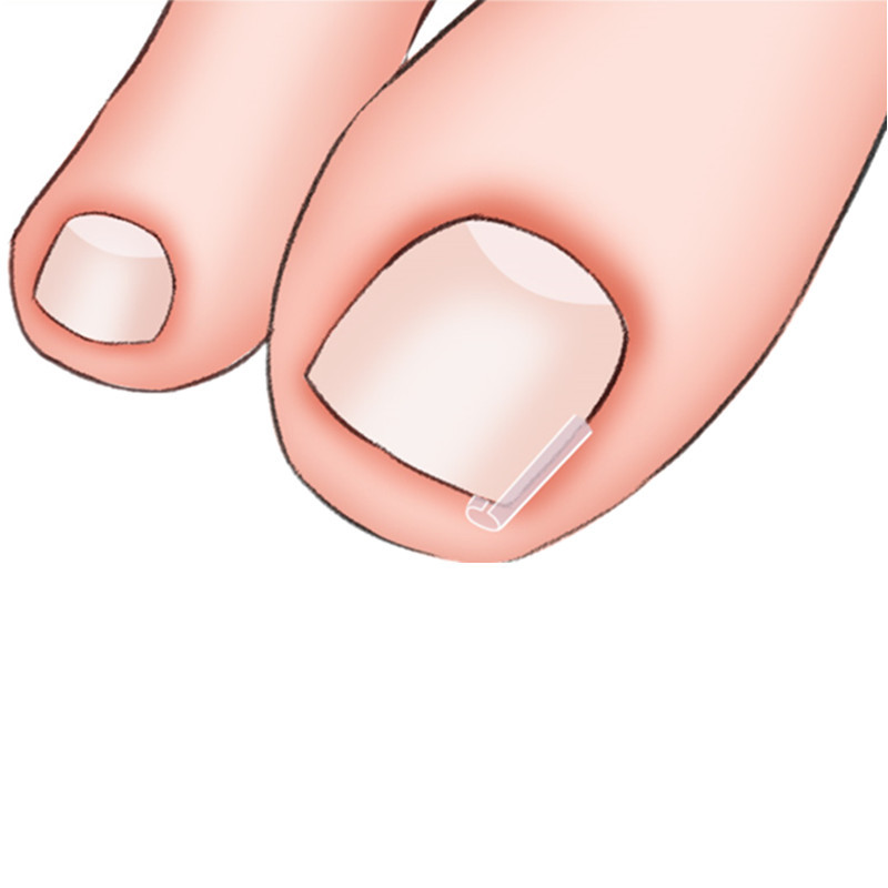 Nail Pad C- shaped Nail Pad Toenail Filling Pad Nail Groove Corrector Paste Nail Paste Nail Paste Toenail Long Meat